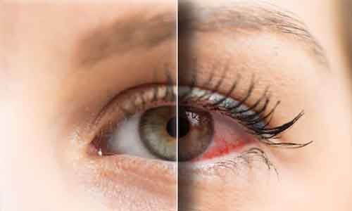 Kala Pharmaceuticals completes Enrollment of STRIDE 3 Trial for EYSUVIS™  for Dry Eye Disease