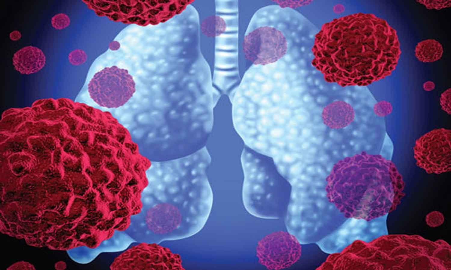 Merck gets Japanese nod for TEPMETKO(tepotinib) for non-small cell lung cancer